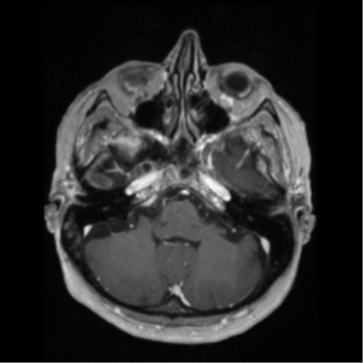 File:Anaplastic astrocytoma IDH wild-type (pseudoprogression) (Radiopaedia 42209-45276 Axial T1 C+ 39).png