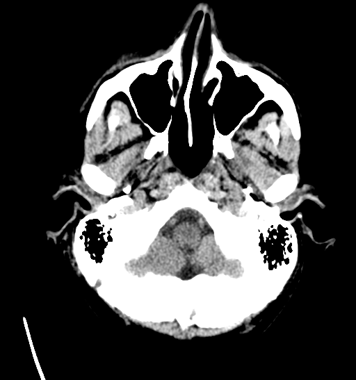 File:Anaplastic meningioma with recurrence (Radiopaedia 34452-35786 Axial non-contrast 5).png