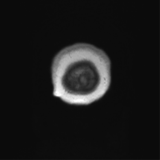 Anaplastic oligodendroglioma (Radiopaedia 83500-98599 Coronal T1 4).png