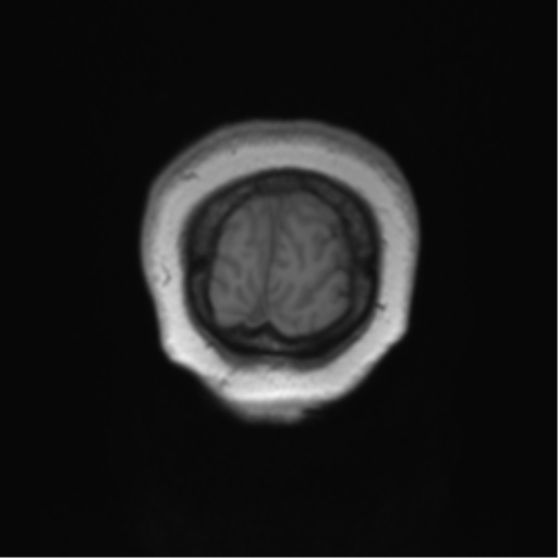 Anaplastic oligodendroglioma (Radiopaedia 83500-98599 Coronal T1 9).png