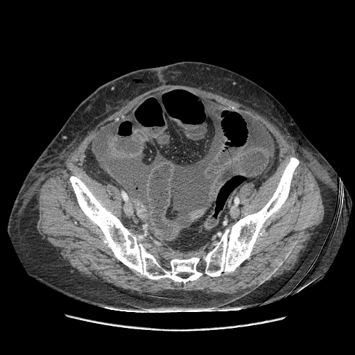 Anastomosis leak at ileostomy closure site (Radiopaedia 82138-96184 B 193).jpg