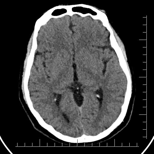 File:Aneurysm of posterior communicating artery (Radiopaedia 20188-20162 Axial non-contrast 23).jpg