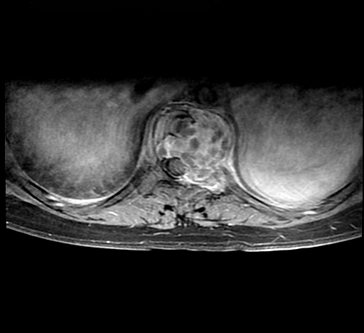 File:Aneurysmal bone cyst (Radiopaedia 9419-10103 Axial T1 1).jpg