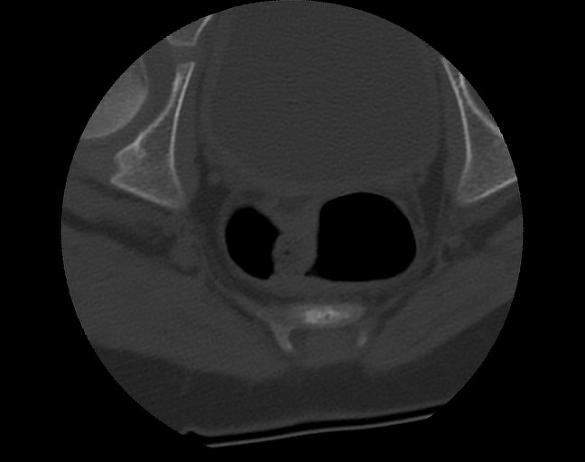 Aneurysmal bone cyst - sacrum (Radiopaedia 65190-74195 Axial bone window 43).jpg