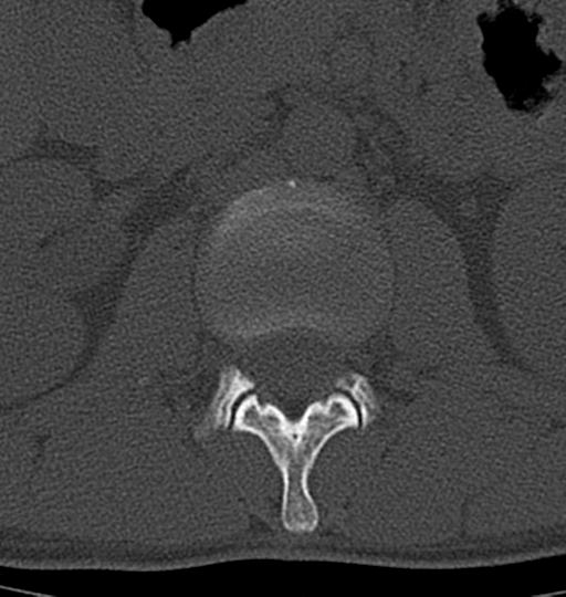 Aneurysmal bone cyst T11 (Radiopaedia 29294-29721 Axial bone window 71).jpg