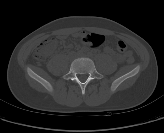 File:Aneurysmal bone cyst of ischium (Radiopaedia 25957-26094 Axial bone window 10).png