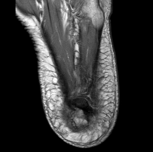 File:Aneurysmal bone cyst of the calcaneus (Radiopaedia 60669-68420 Axial PD 2).jpg