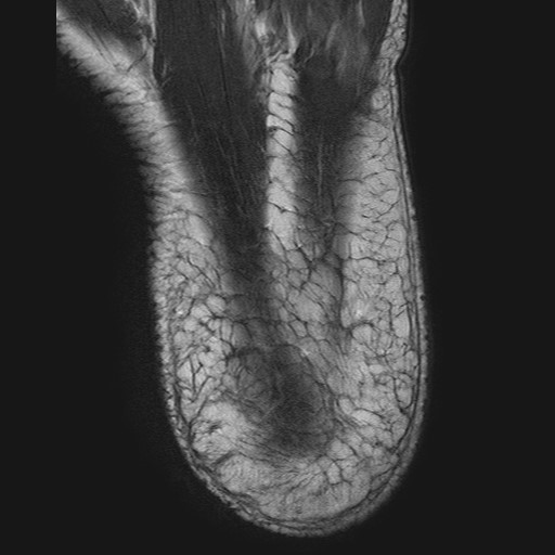 File:Aneurysmal bone cyst of the calcaneus (Radiopaedia 60669-68420 Axial T2 1).jpg