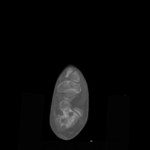 File:Aneurysmal bone cyst of the calcaneus (Radiopaedia 60669-68421 Axial bone window 5).jpg