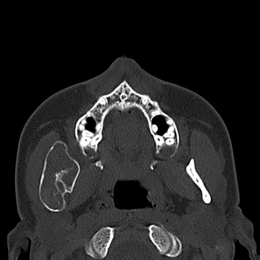 Aneurysmal bone cyst of the mandible (Radiopaedia 43280-46601 Axial bone window 52).jpg