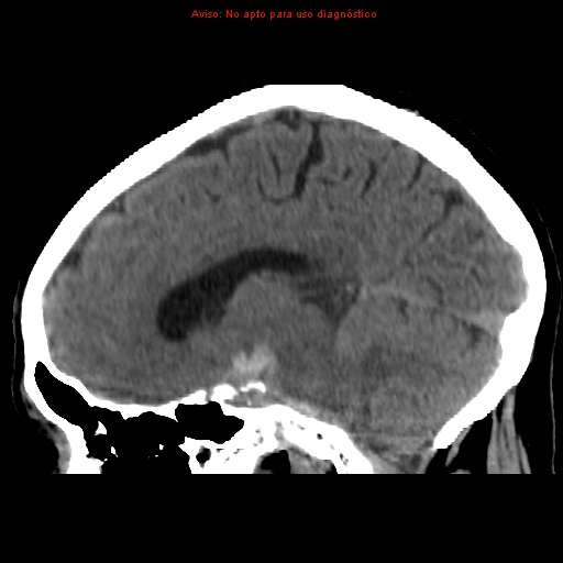 File:Aneurysmal subarachnoid hemorrhage (Radiopaedia 24740-24997 non-contrast 29).jpg