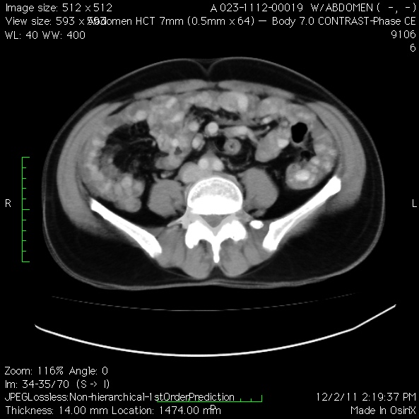 File:Angiodysplasia of the small bowel (Radiopaedia 16387-16075 D 1).jpg