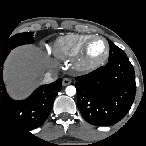 Anomalous left coronary artery from the pulmonary artery (ALCAPA) (Radiopaedia 70148-80181 A 335).jpg