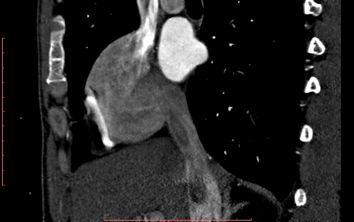 File:Anomalous left coronary artery from the pulmonary artery (ALCAPA) (Radiopaedia 70148-80181 C 39).jpg