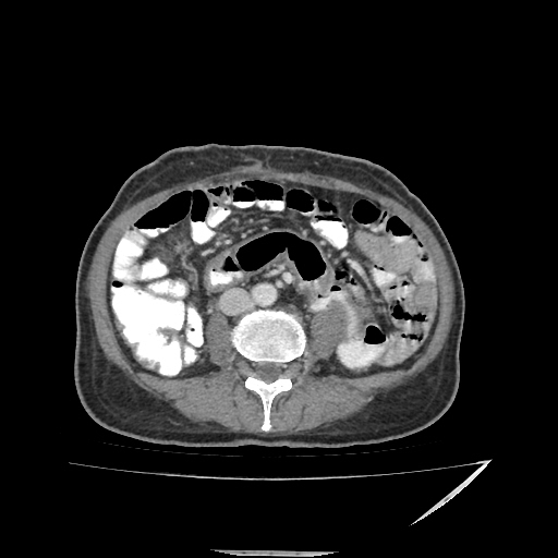 Anorectal carcinoma (Radiopaedia 44413-48064 A 31).jpg