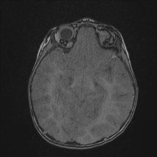 Anoxic brain injury (Radiopaedia 79165-92139 Axial MRA 103).jpg