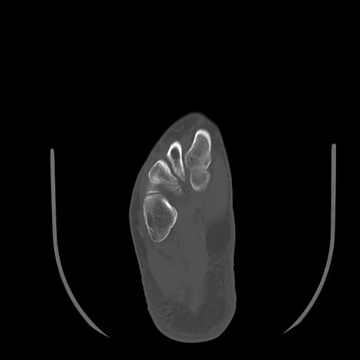 Anterior calcaneal process fracture (Radiopaedia 82590-96762 Axial bone window 31).jpg