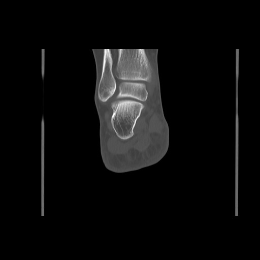 File:Anterior calcaneal process fracture (Radiopaedia 82590-96762 Coronal bone window 59).jpg