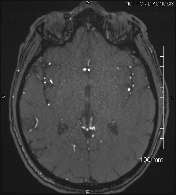 Anterior cerebral artery aneurysm (Radiopaedia 80683-94127 Axial MRA 122).jpg