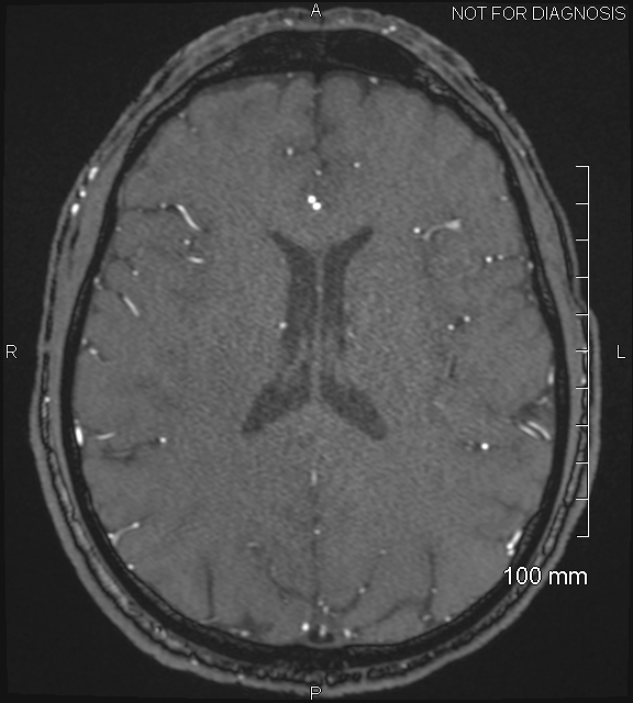 Anterior cerebral artery aneurysm (Radiopaedia 80683-94127 Axial MRA 152).jpg