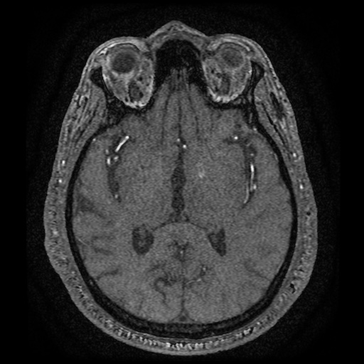 Anterior cerebral artery infarction (Radiopaedia 46794-51323 Axial MRA 104).jpg