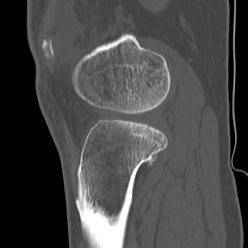File:Anterior cruciate ligament avulsion fracture (Radiopaedia 58939-66194 Sagittal bone window 10).jpg