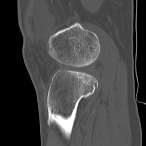 File:Anterior cruciate ligament avulsion fracture (Radiopaedia 58939-66194 Sagittal bone window 9).jpg
