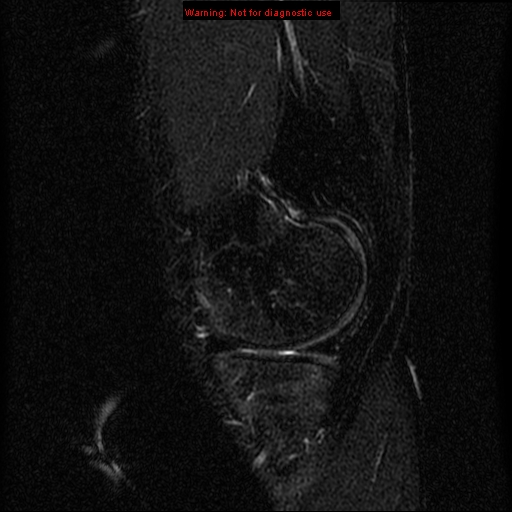 File:Anterior cruciate ligament injury - partial thickness tear (Radiopaedia 12176-12515 Sagittal T2 fat sat 4).jpg