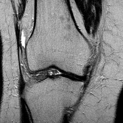 File:Anterior cruciate ligament mucoid degeneration (Radiopaedia 60853-68633 Coronal T2 13).jpg