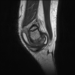 Anterior cruciate ligament tear - pediatric (Radiopaedia 62152-70260 Sagittal PD 26).jpg