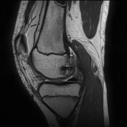 File:Anterior cruciate ligament tear - pediatric (Radiopaedia 62152-70260 Sagittal PD 67).jpg