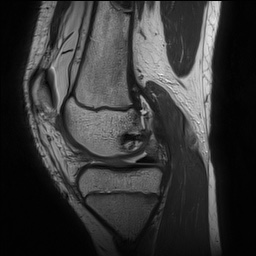 File:Anterior cruciate ligament tear - pediatric (Radiopaedia 62152-70260 Sagittal PD 68).jpg