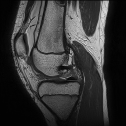 Anterior cruciate ligament tear - pediatric (Radiopaedia 62152-70260 Sagittal PD 70).jpg