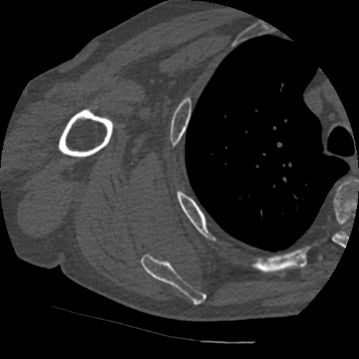 Anterior glenohumeral dislocation with Hill-Sachs lesion (Radiopaedia 62877-71249 Axial bone window 65).jpg