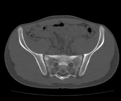 Anterior inferior iliac spine avulsion fracture (Radiopaedia 81312-94999 Axial bone window 31).jpg