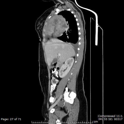 File:Anterior mediastinal B cell Lymphoma (Radiopaedia 50677-56114 C 14).jpg