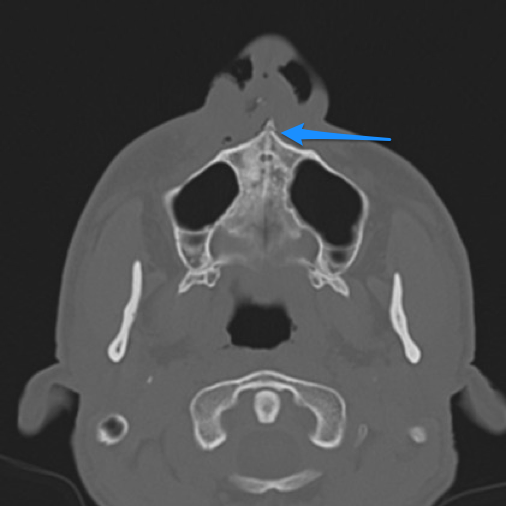 File:Anterior nasal spine fracture (Radiopaedia 46138-50529 Axial bone window 1).png