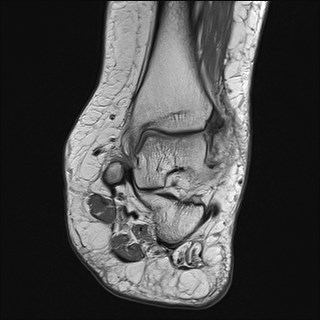 File:Anterior talofibular ligament injury - rupture with soft-tissue impingement (Radiopaedia 38765-40928 Coronal PD 19).jpg