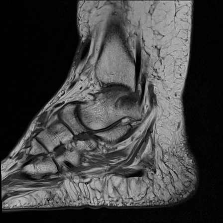 File:Anterior talofibular ligament injury - rupture with soft-tissue impingement (Radiopaedia 38765-40928 Sagittal PD 6).jpg