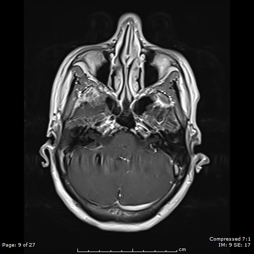 File:Anterior temporal lobe perivascular space (Radiopaedia 88283-104914 Axial T1 C+ 9).jpg