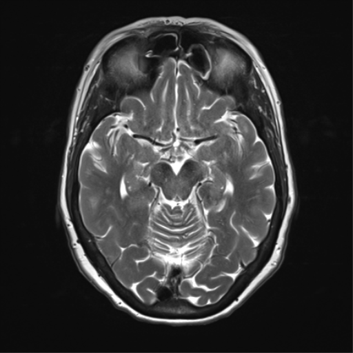 File:Anterior temporal pole cysts (Radiopaedia 46629-51102 C 16).png