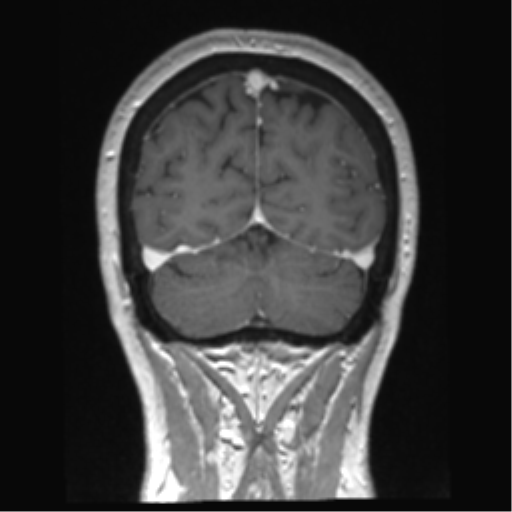 Anterior temporal pole cysts (Radiopaedia 46629-51102 Coronal T1 C+ 38).png