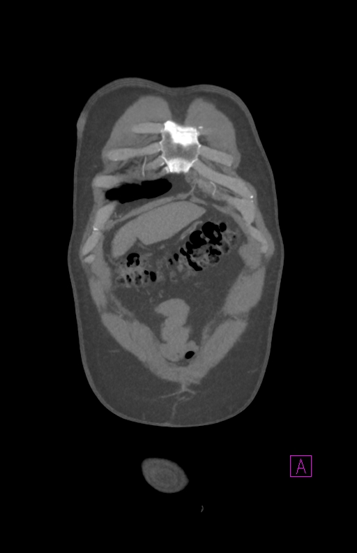 Aortectomy and axillary-bifemoral bypass (Radiopaedia 28303-28545 C 13).jpg