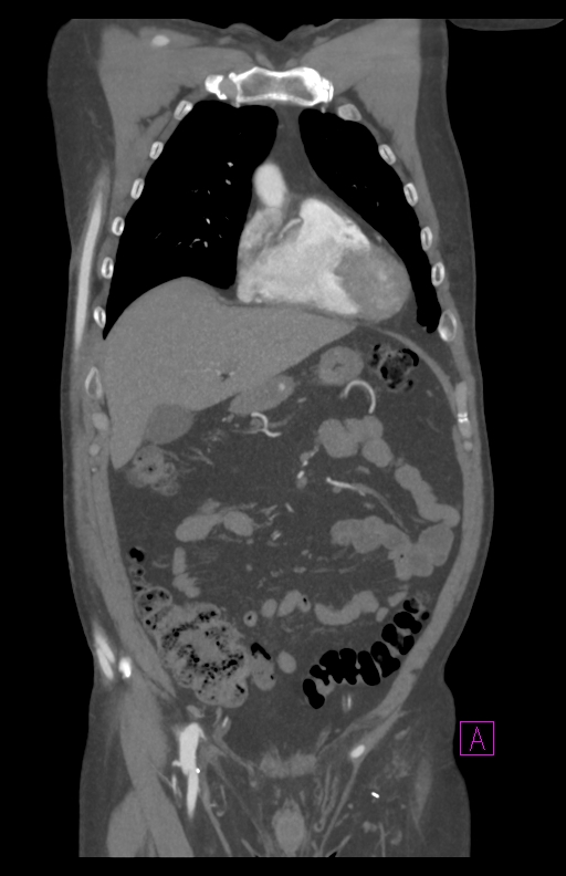 Aortectomy and axillary-bifemoral bypass (Radiopaedia 28303-28545 C 29).jpg