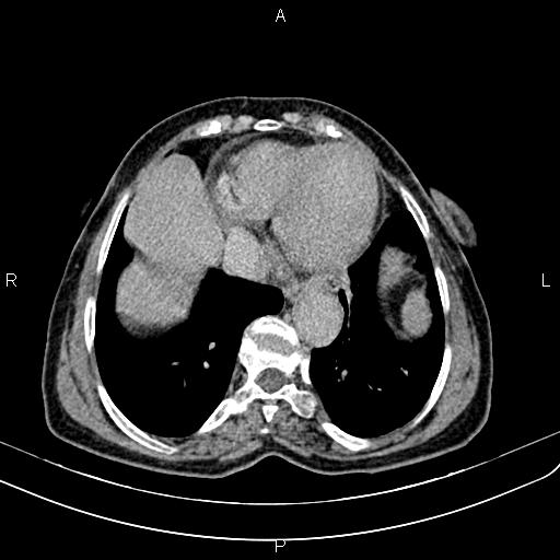 Aortic aneurysm and Lemmel syndrome (Radiopaedia 86499-102554 Axial C+ delayed 6).jpg