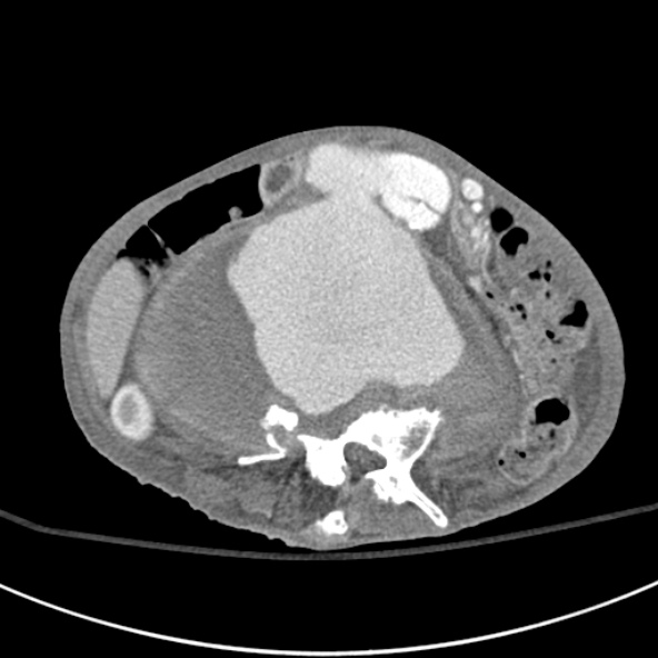 File:Aortic aneurysm with spinal destruction (Radiopaedia 42301-45410 A 51).jpg