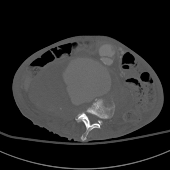 Aortic aneurysm with spinal destruction (Radiopaedia 42301-45410 Axial bone window 57).jpg