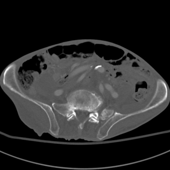 Aortic aneurysm with spinal destruction (Radiopaedia 42301-45410 Axial bone window 75).jpg