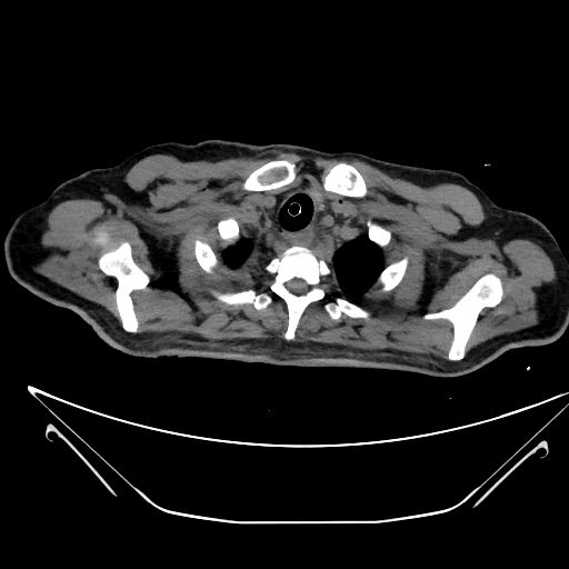 Aortic arch aneurysm (Radiopaedia 84109-99365 Axial non-contrast 34).jpg