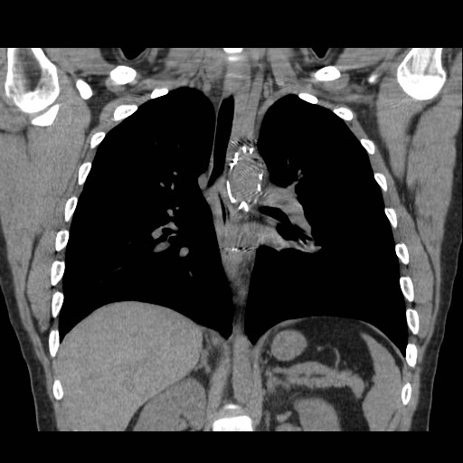 File:Aortic arch stent (Radiopaedia 30030-30595 Coronal non-contrast 16).jpg